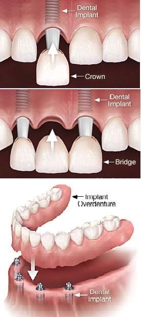 Implants Dentures Empire AL 35063